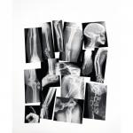 Broken Bones X-Ray Set