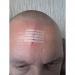 HypaCover Skin Closure Strips D4721